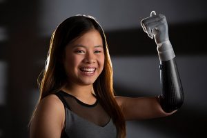 Sophia's prosthetic robotic arm